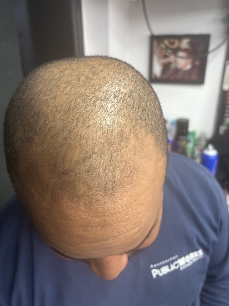 Same trial participant after a consistent scalp routine